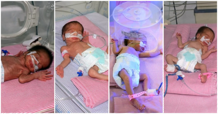 حالة نادرة ولادة 4 توائم في مستشفى الراعي