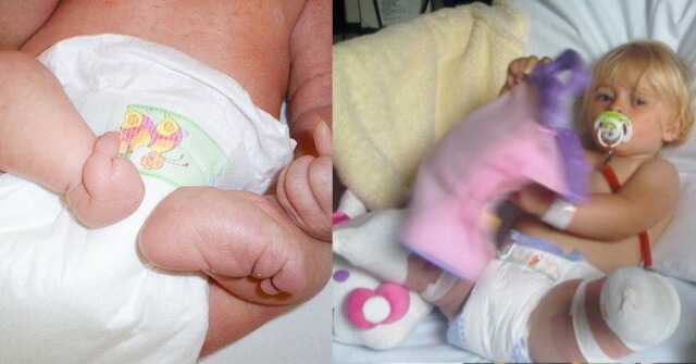 ولدت الطفلة ديزي ماي-ديميتر بعيب خلقي في ساقيها، فاضطر الأطباء الى بترهما.
