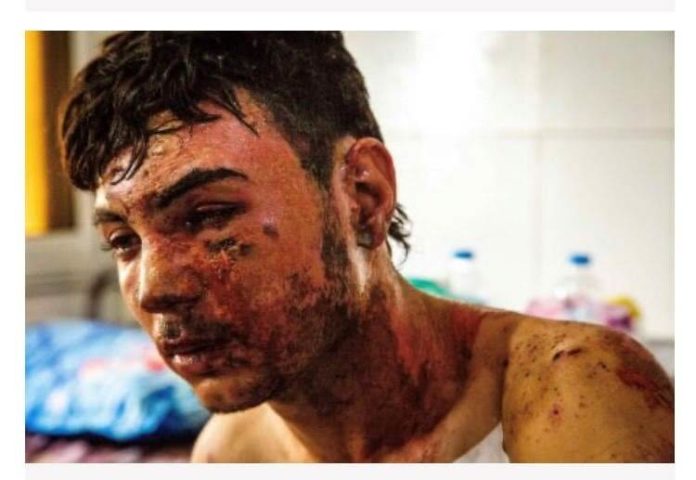 الحروق والإصابات المروعة أثبتت أَن تركيا استخدمت الفوسفور الأبيض في غزوها لمناطق الأكراد