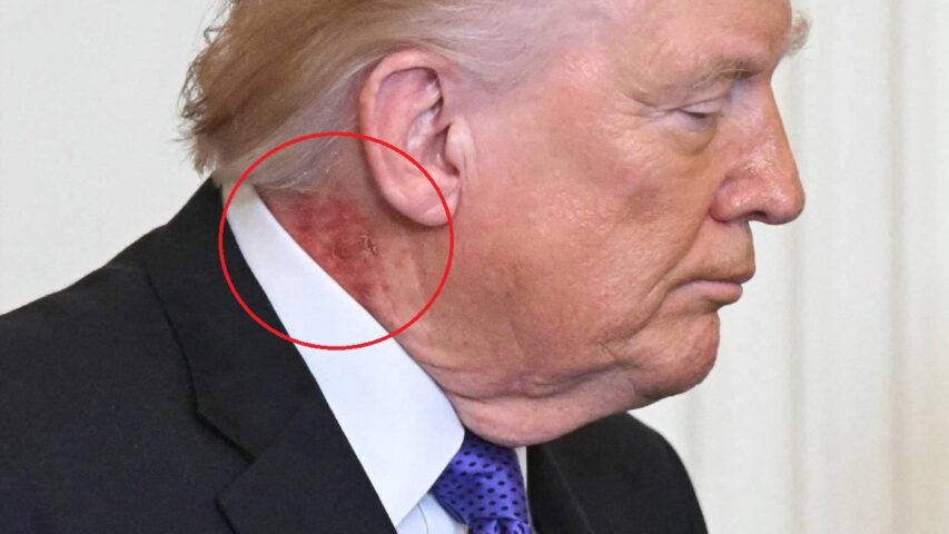 Trump neck rash